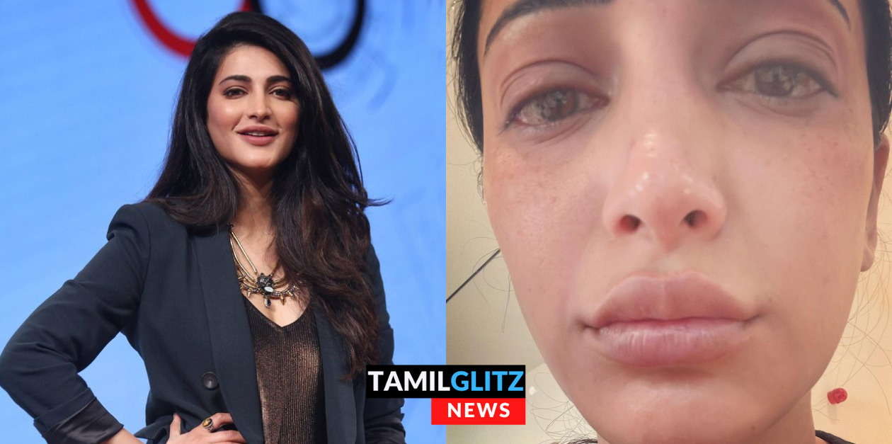 முகம் உதடு எல்லாம் வீங்கி போய் விகாரமாக மாறிய ஸ்ருதி ஹாசன்.! என்னாச்சு அவருக்கு? 73